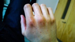 Bruised knuckles